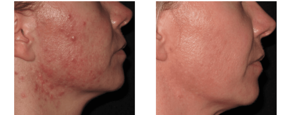 Before and after images of facial skin treatment showing improvement in texture and reduction of acne scars from Lutronic RF microneedling at Shore MedSpa.