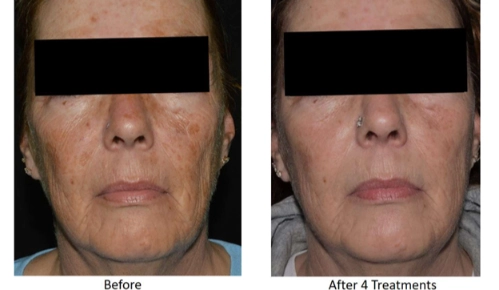 Before and after images of a woman's face showing skin improvement after four Lutronic RF microneedling treatments at Shore Dermatology, highlighting enhanced skin texture and reduced pigmentation.